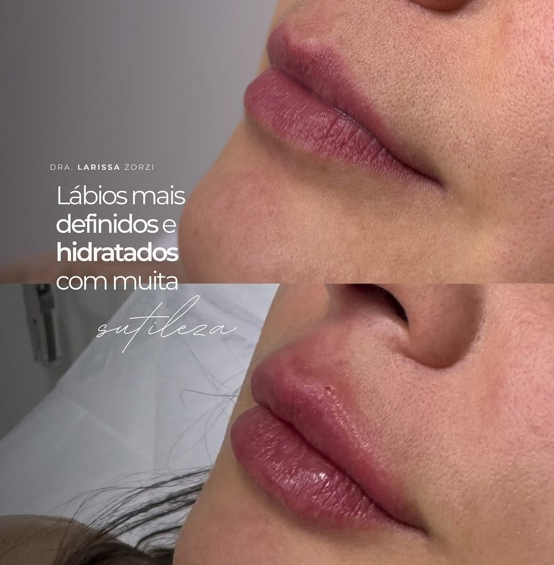 Caso Clínico 3 - Harmonização Facial Dra. Larissa Zorzi