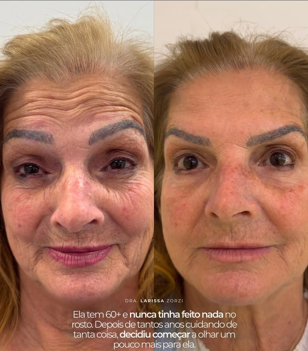 Caso Clínico 2 - Harmonização Facial Dra. Larissa Zorzi