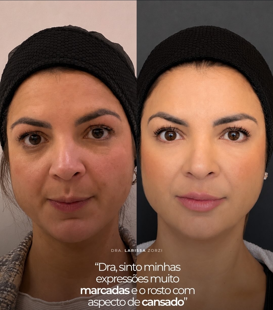 Caso Clínico 1 - Harmonização Facial Dra. Larissa Zorzi